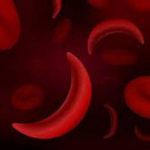 EUA aprovam terapias de edição genética para tratar anemia falciforme